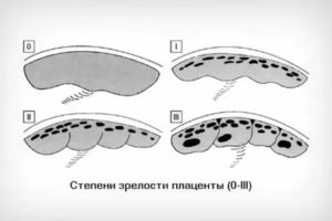 Как остановить раннее старение плаценты