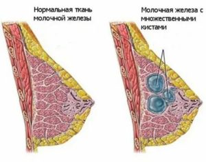 Почему набухли грудные железы что это такое