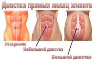 Можно ли беременеть при диастазе прямых мышц живота