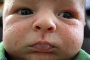 Как и чем убрать аллергию у новорожденного на лице