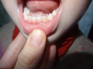 Почему у грудного ребенка желтеют зубы