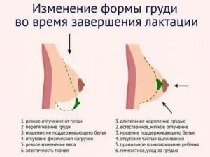 Как перетягивать грудное молоко эластичным бинтом