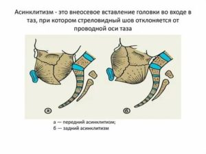 Что такое асинклитическое вставление головки плода