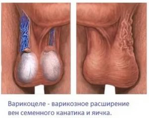 Может ли фимоз быть причиной бесплодия у мужчин