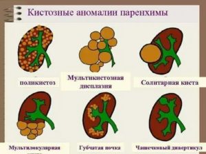 Что такое мультикистозная дисплазия правой почки плода