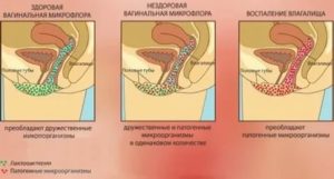 Как влияет дисбактериоз влагалища при зачатии