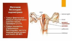 Что такое женское бесплодие маточного происхождения