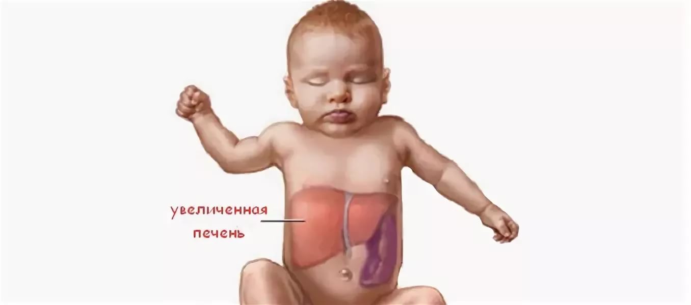 Увеличена печень у новорожденного. Синдром гепатоспленомегалия симптомы. Гепатоспленомегалия у новорожденного. Гепатомегалия у новорожденных детей. Гепатомегалия печени у малыша.