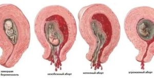 Может ли при замершем плоде быть токсикоз