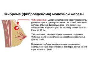 Что такое фибром грудной железы у мужчин