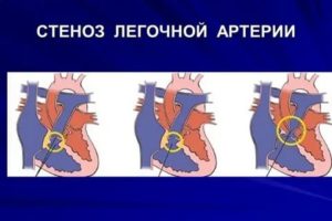 Что такое клапанный стеноз легочной артерии у плода