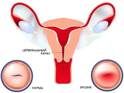 Чем опасна эрозия шейки матки при планировании беременности