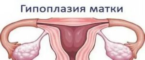 Можно ли родить с гипоплазией матки 1 степени