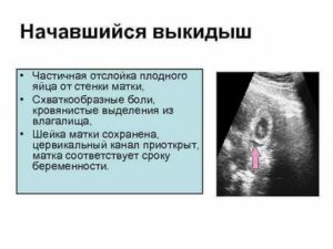 Как правильно лежать при отслойке плодного яйца