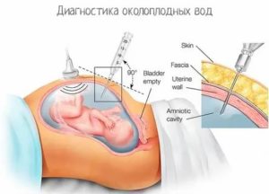 Что такое анализ на околоплодные воды и как он делается