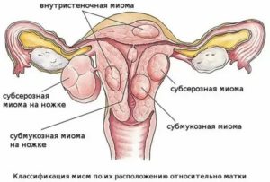 Кто беременел при субмукозной миоме