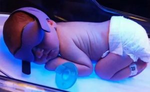 Сколько времени проводится фототерапия новорожденному