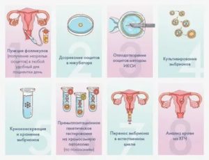 Какие способы забеременеть существуют кроме эко