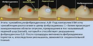 Что такое фибром грудной железы у мужчин