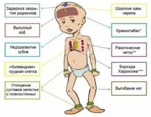 Можно ли вылечить рахит у грудничков до года