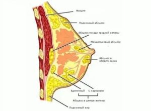 Что такое абсцессы в грудных железах