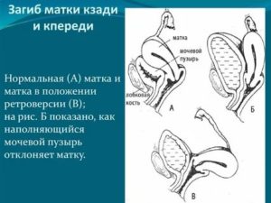 Можно ли беременеть при загибе матки