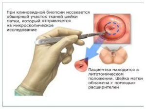 Когда после биопсии шейки матки можно беременеть после