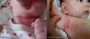 Чем обрабатывать складки новорожденного на шее при покраснении