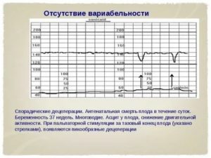 Как подготовиться к ктг плода утром