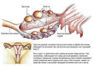 Как лечить поликистоз яичников для планирования беременности
