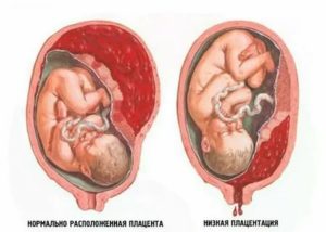 Когда поднимается плацента при низкой плацентации какие ощущения