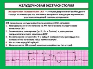 Что такое экстрасистолы у новорожденных