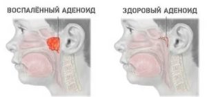 Может ли грудничок дышать ртом если не дышит нос