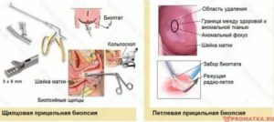 Когда после биопсии шейки матки можно беременеть после