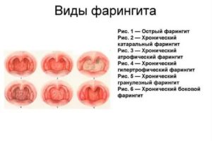 Сколько времени лечится фарингит у грудных детей