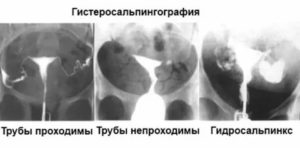 Через сколько дней после гсг можно планировать беременность после