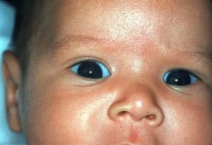 Почему у новорожденного голубые белки