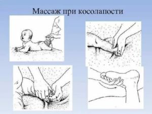 Как делать массаж новорожденному при косолапии