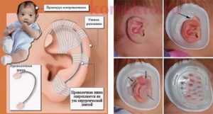 Что делать если у новорожденного заворачиваются ушки