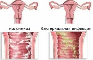 Может ли быть хроническая молочница причиной бесплодия