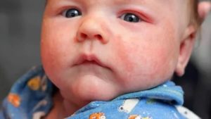 Как избавиться от диатеза у грудного ребенка на щеках