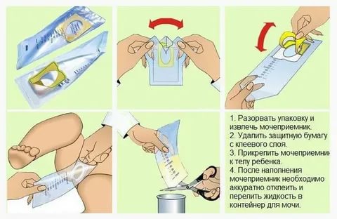 Как собрать анализ мочи у новорожденной девочки с помощью мочеприемника