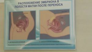 В какой позе лучше лежать после переноса эмбрионов