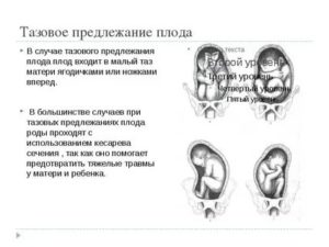 Что означает неустойчивое предлежание плода