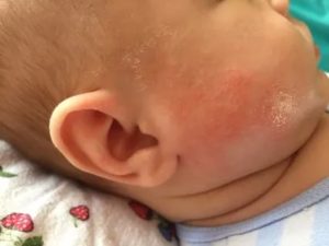 Как распознать аллергию у грудного ребенка на смесь признаки