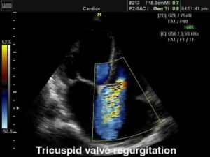 Что такое дисплазия трикуспидального клапана у плода