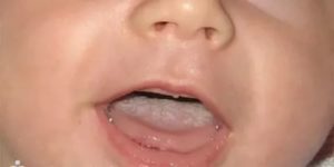 Что делать если у грудного ребенка белый налет во рту