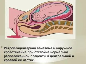 Можно ли заниматься сексом во время отслойки плаценты