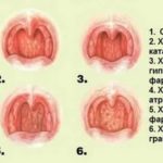 Могут ли быть глисты у новорожденных детей