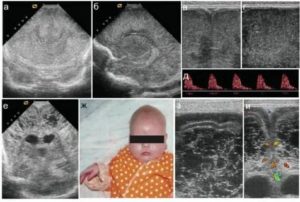 Что такое повышение эхогенности в пво у новорожденного